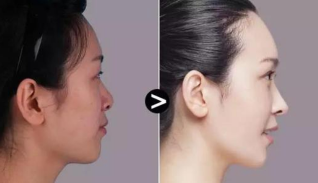 蘭州明倫醫(yī)療美容門診部假體豐額頭