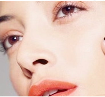 南昌佳美整形美容醫(yī)院假體隆鼻