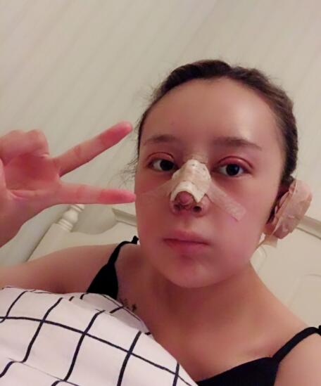 上海時(shí)光整形外科醫(yī)院雙眼皮+隆鼻+下頜角案例