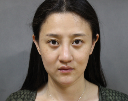 上海時(shí)光整形醫(yī)院自體脂肪填充臉部真實(shí)效果圖分享