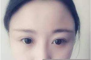 鄭州集美美容醫(yī)院自體脂肪那豐太陽穴