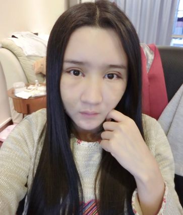 上海時(shí)光整形醫(yī)院自體脂肪填充臉部真實(shí)效果圖分享