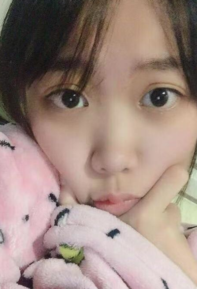 合肥韓美整形美容醫(yī)院做去眼袋效果怎么樣?附金壽信醫(yī)生去眼袋案例效果圖