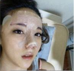 上海時光整形醫(yī)生何晉龍做假體隆鼻效果怎么樣？附案例效果對比圖