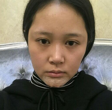 上海時光整形醫(yī)院做豐下巴怎么樣？許黎平醫(yī)生豐下巴案例分享