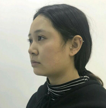 上海時光整形醫(yī)院做豐下巴怎么樣？許黎平醫(yī)生豐下巴案例分享