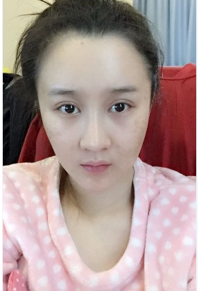 上海時(shí)光整形醫(yī)院自體脂肪填充臉部真實(shí)效果圖分享