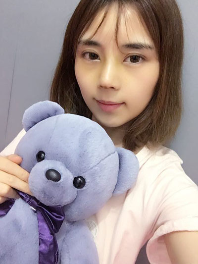 合肥韓美整形醫(yī)院做隆鼻手術(shù)效果怎么樣?附金壽信醫(yī)生案例