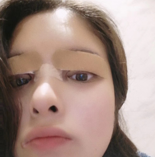 合肥韓美整形醫(yī)院做雙眼皮+開眼角效果怎么樣?附石顯武醫(yī)生真實案例效果圖