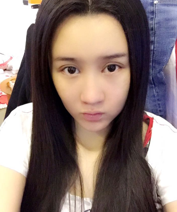 上海時(shí)光整形醫(yī)院自體脂肪填充臉部真實(shí)效果圖分享