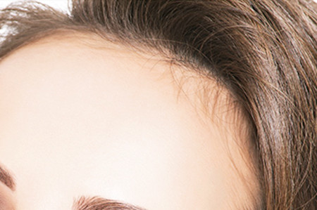 長(zhǎng)沙美萊醫(yī)療美容醫(yī)院自體脂肪豐額頭