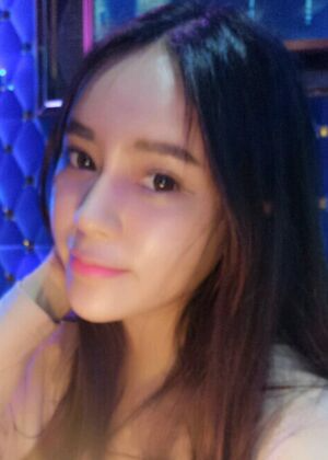 鞍山王景醫(yī)療美容外科診所做自體脂肪豐蘋(píng)果肌效果怎么樣？附張婉鸝案例效果圖