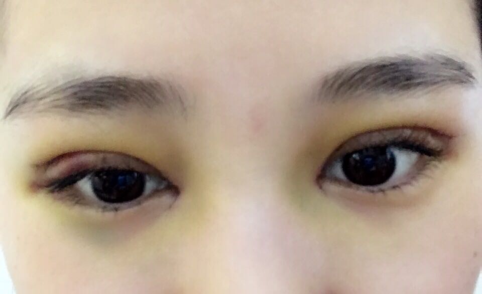 蚌埠韓美美萊整形醫(yī)生鄭捷做開(kāi)眼角怎么樣？附案例效果圖