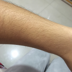 蚌埠市第三人民醫(yī)院燒傷整形科李勇醫(yī)生做手臂激光脫毛案例效果圖