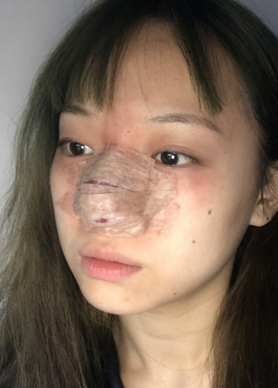 蚌埠韓美美萊整形做手術(shù)縮鼻頭效果怎么樣？附周娜醫(yī)生縮鼻頭案例效果圖