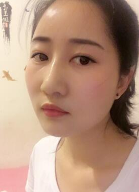 鞍山菲之都整形醫(yī)生李宗亮做字體脂肪豐太陽穴效果怎么樣？附案例效果對比圖