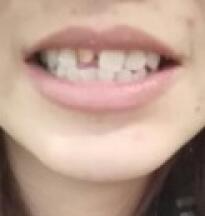 鞍山時(shí)代口腔門(mén)診部劉昕醫(yī)生做美容冠效果怎么樣？一起來(lái)看看吧