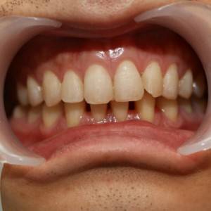 鞍山時(shí)代口腔門診部做瓷貼面案例效果圖