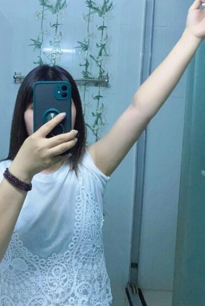 蚌埠市第三人民醫(yī)院燒傷整形科楊蔚做手臂吸脂效果對(duì)比圖 蚌埠市第三人民醫(yī)院燒傷整形科楊蔚做手臂吸脂效果對(duì)比圖