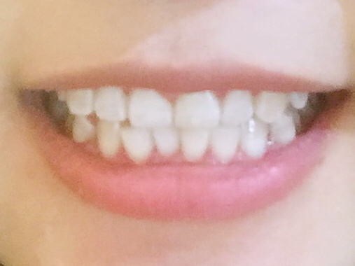 安慶渡江口腔醫(yī)院張良斌醫(yī)生做超聲波洗牙效果怎么樣？附洗牙案例效果圖