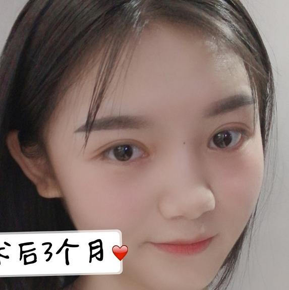 鞍山菲之都醫(yī)療整形醫(yī)院做開(kāi)眼角+全切雙眼皮效果怎么樣？附藺嬌婷醫(yī)生案例