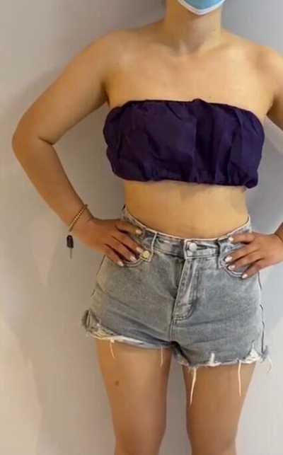 蚌埠市第三人民醫(yī)院燒傷整形科楊蔚做手臂吸脂效果對比圖