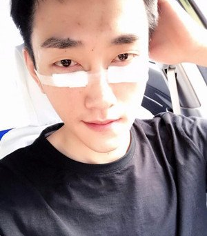 鞍山燕麗醫(yī)療美容醫(yī)院薛媚醫(yī)生做去眼袋效果怎么樣？附案例效果對比圖