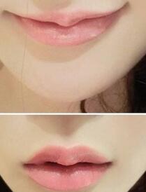 巴中時光醫(yī)學(xué)美容門診部做玻尿酸豐唇效果怎么樣？附李紅強豐唇案例
