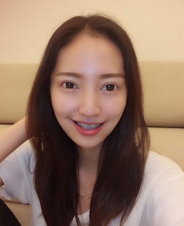 巴中華醫(yī)口腔醫(yī)院做牙齒矯正效果好嗎？附母汶靈醫(yī)生牙齒矯正案例效果圖