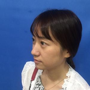 蚌埠韓美美萊整形做玻尿酸面部除皺效果怎么樣？附陳澤醫(yī)生案例效果圖