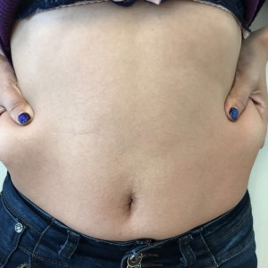 蚌埠韓美美萊整形醫(yī)生張濤做水動(dòng)力吸脂怎么樣？附吸脂案例效果圖