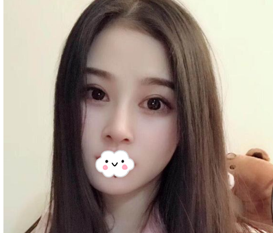 蚌埠韓美美萊整形醫(yī)生歷芳做耳軟骨隆鼻怎么樣？附耳軟骨隆鼻案例對比圖
