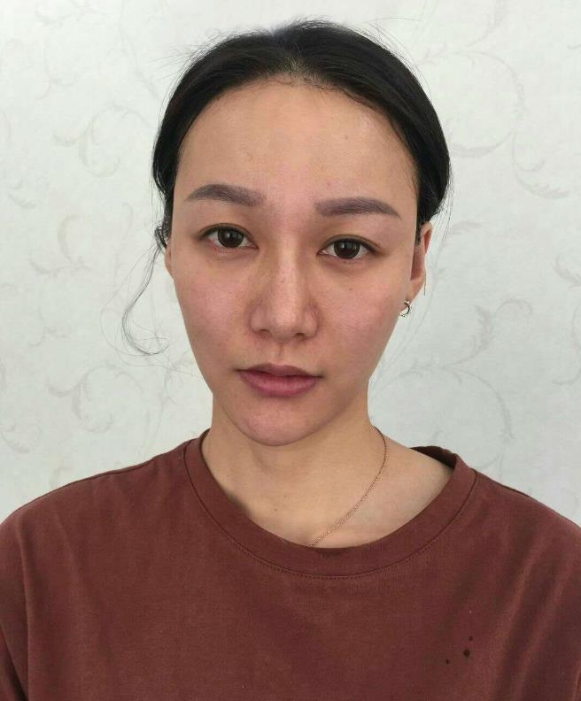 鞍山王景醫(yī)療美容外科診所做光子嫩膚怎么樣？附王景醫(yī)生案例效果圖