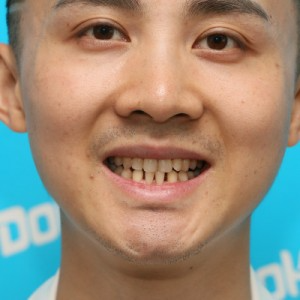 鞍山時代口腔門診部做瓷貼面怎么樣？附孫興國醫(yī)生瓷貼面案例效果圖