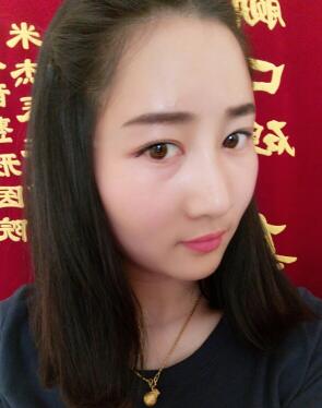 鞍山菲之都整形醫(yī)生李宗亮做字體脂肪豐太陽穴效果怎么樣？附案例效果對比圖