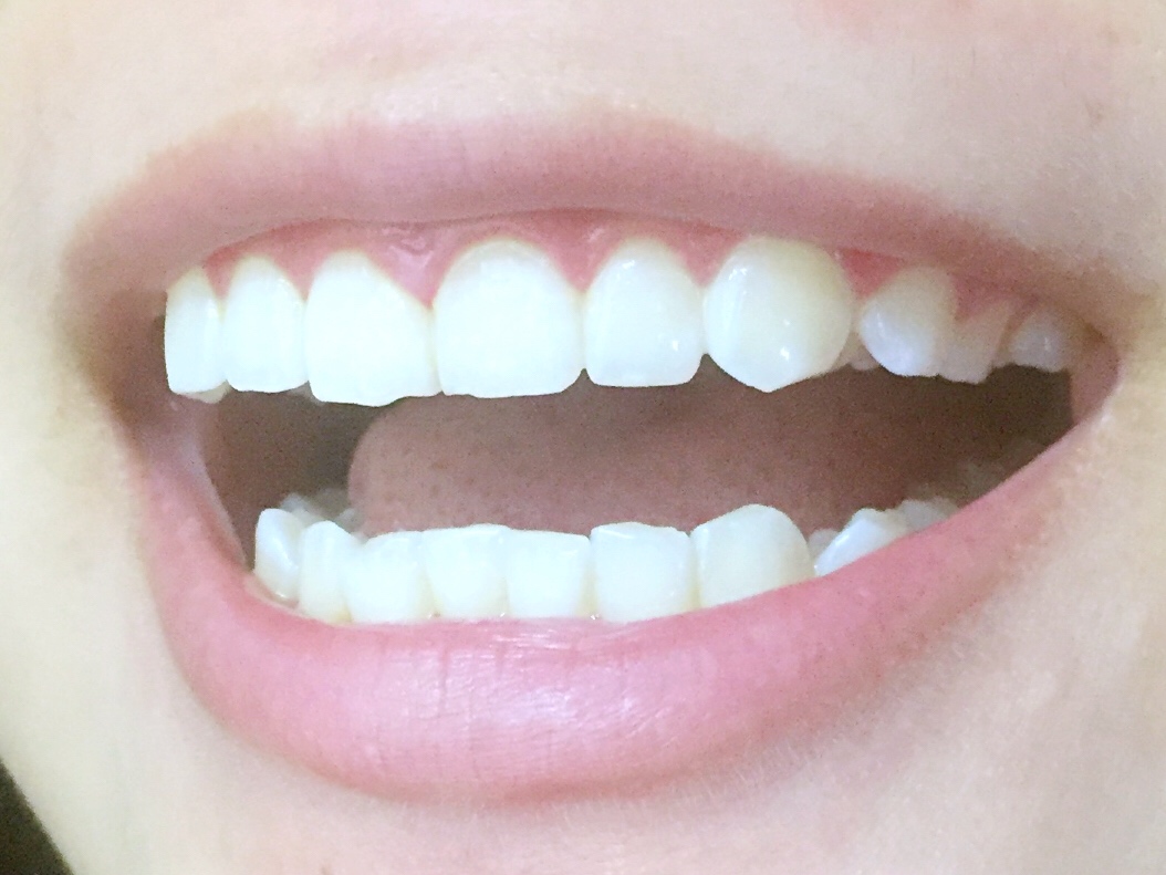 安慶渡江口腔醫(yī)院張良斌醫(yī)生做超聲波洗牙效果怎么樣？附洗牙案例效果圖