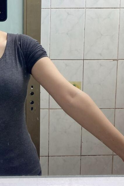 蚌埠市第三人民醫(yī)院燒傷整形科楊蔚做手臂吸脂效果對(duì)比圖 蚌埠市第三人民醫(yī)院燒傷整形科楊蔚做手臂吸脂效果對(duì)比圖