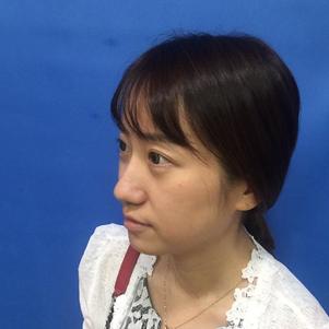 蚌埠韓美美萊整形做玻尿酸面部除皺效果怎么樣？附陳澤醫(yī)生案例效果圖