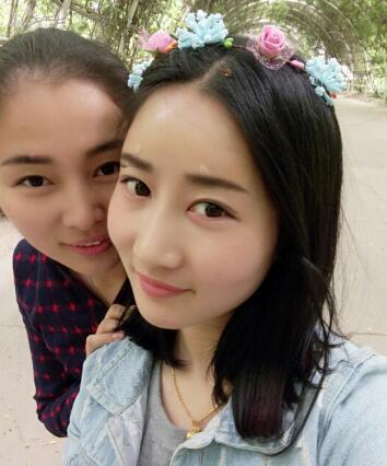 鞍山菲之都整形醫(yī)生李宗亮做字體脂肪豐太陽穴效果怎么樣？附案例效果對比圖