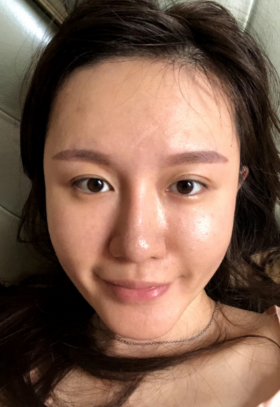 蚌埠韓美美萊整形醫(yī)生張燕做自體脂肪豐面頰效果怎么樣？附案例效果圖