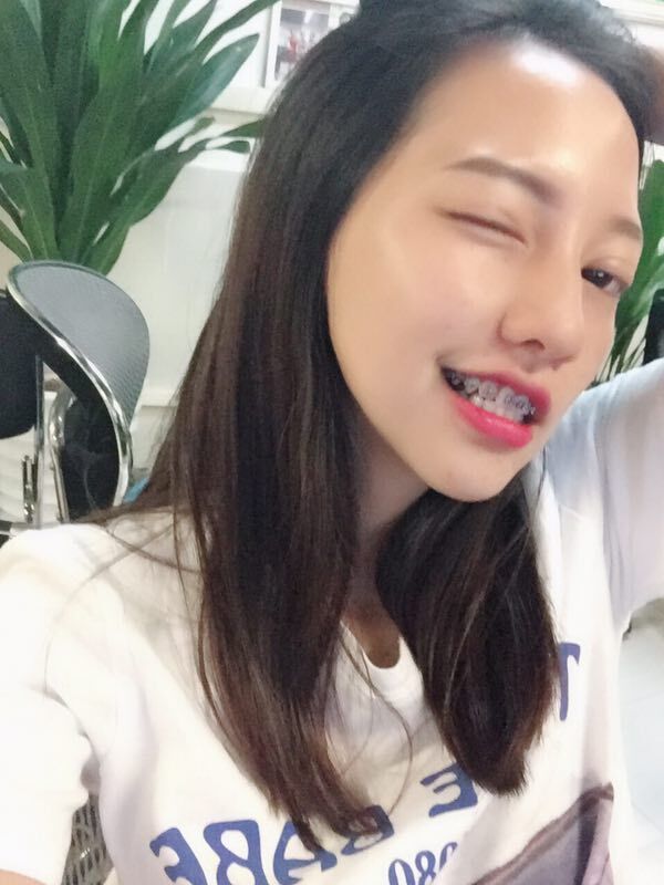 巴中華醫(yī)口腔醫(yī)院做牙齒矯正效果好嗎？附母汶靈醫(yī)生牙齒矯正案例效果圖