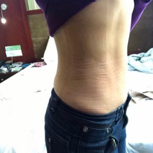 蚌埠韓美美萊整形醫(yī)生張濤做水動(dòng)力吸脂怎么樣？附吸脂案例效果圖