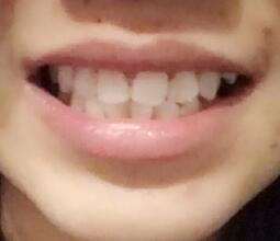 鞍山時(shí)代口腔門(mén)診部劉昕醫(yī)生做美容冠效果怎么樣？一起來(lái)看看吧