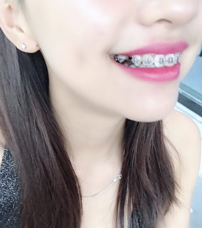 巴中華醫(yī)口腔醫(yī)院做牙齒矯正效果好嗎？附母汶靈醫(yī)生牙齒矯正案例效果圖