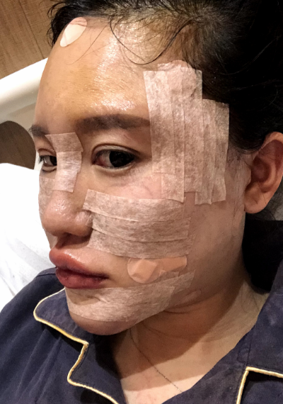 蚌埠韓美美萊整形醫(yī)生張燕做自體脂肪豐面頰效果怎么樣？附案例效果圖