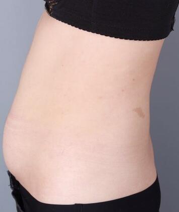 保定現(xiàn)代女子醫(yī)院整形美容中心做腰腹部吸脂怎么樣？附林秀蓮醫(yī)生案例效果圖