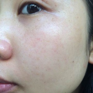 寶雞皮膚病醫(yī)院文東亮醫(yī)生做臉部祛斑效果怎么樣？附臉部祛斑案例