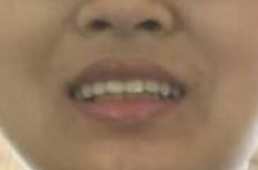 保定東陽口腔醫(yī)院馮春城醫(yī)生做烤瓷牙怎么樣?附烤瓷牙案例效果對比圖 保定東陽口腔醫(yī)院馮春城醫(yī)生做烤瓷牙怎么樣?附烤瓷牙案例效果對比圖