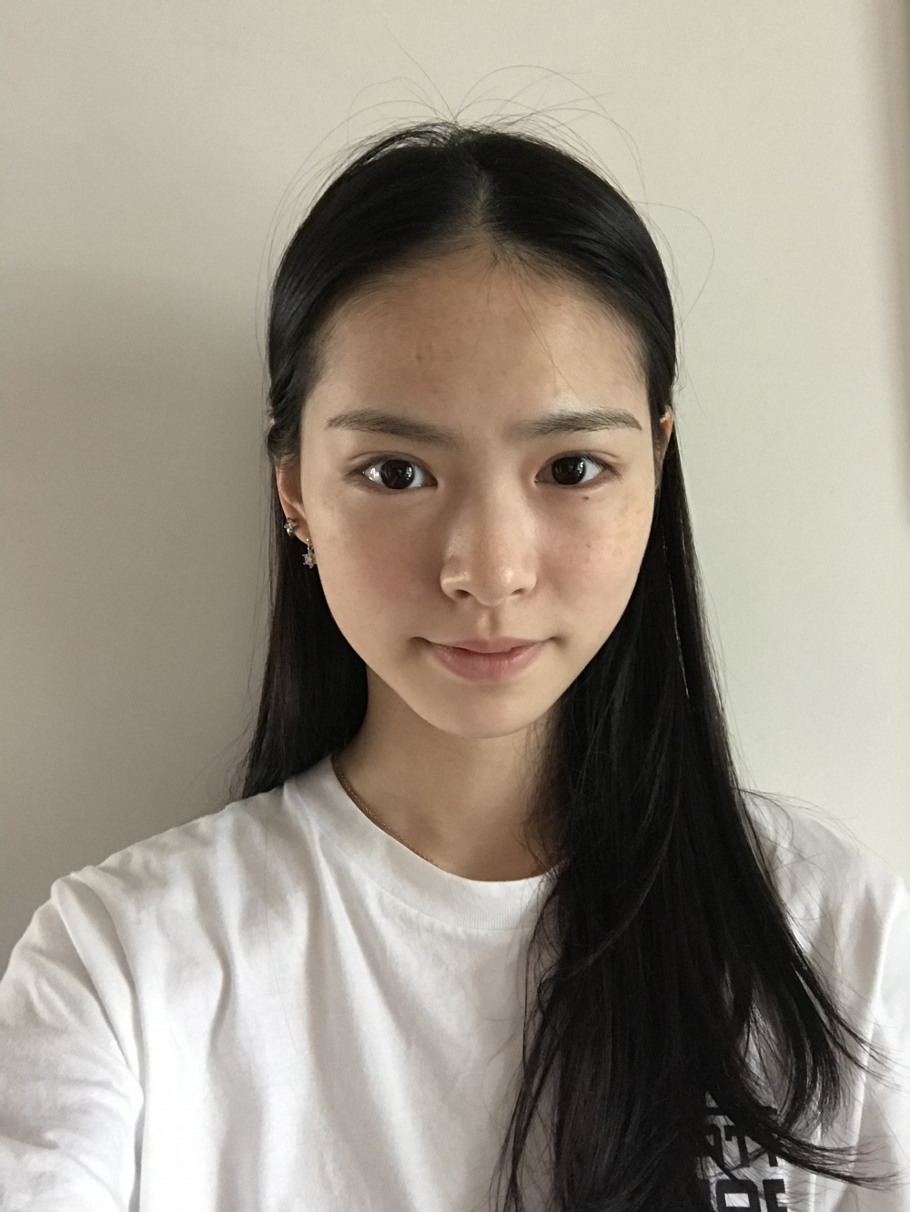 保定市第五醫(yī)院美容整形科做激光祛斑怎么樣？附單敬依醫(yī)生案例效果圖