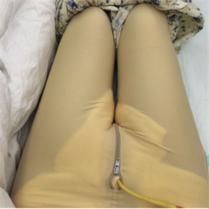 保定市第五醫(yī)院美容整形科做大腿吸脂怎么樣？附劉根立醫(yī)生案例效果圖